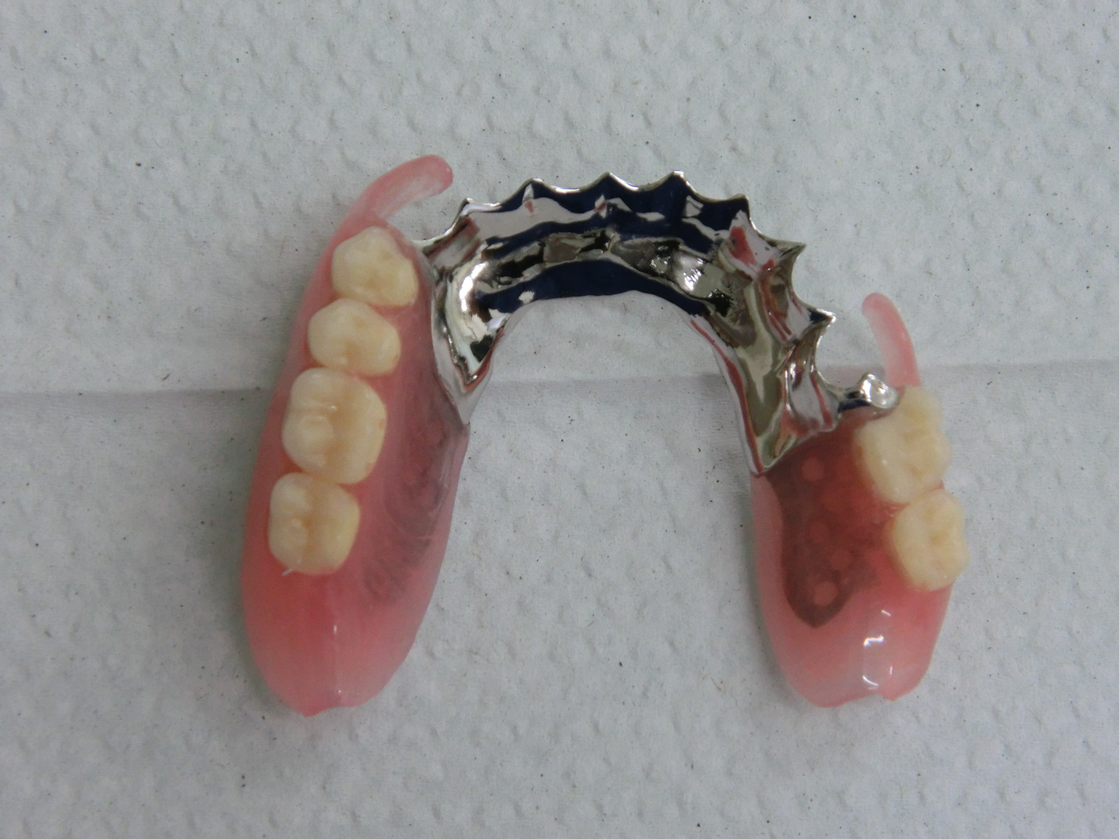 清藤歯科医院-入れ歯・義歯-コンビネーション義歯