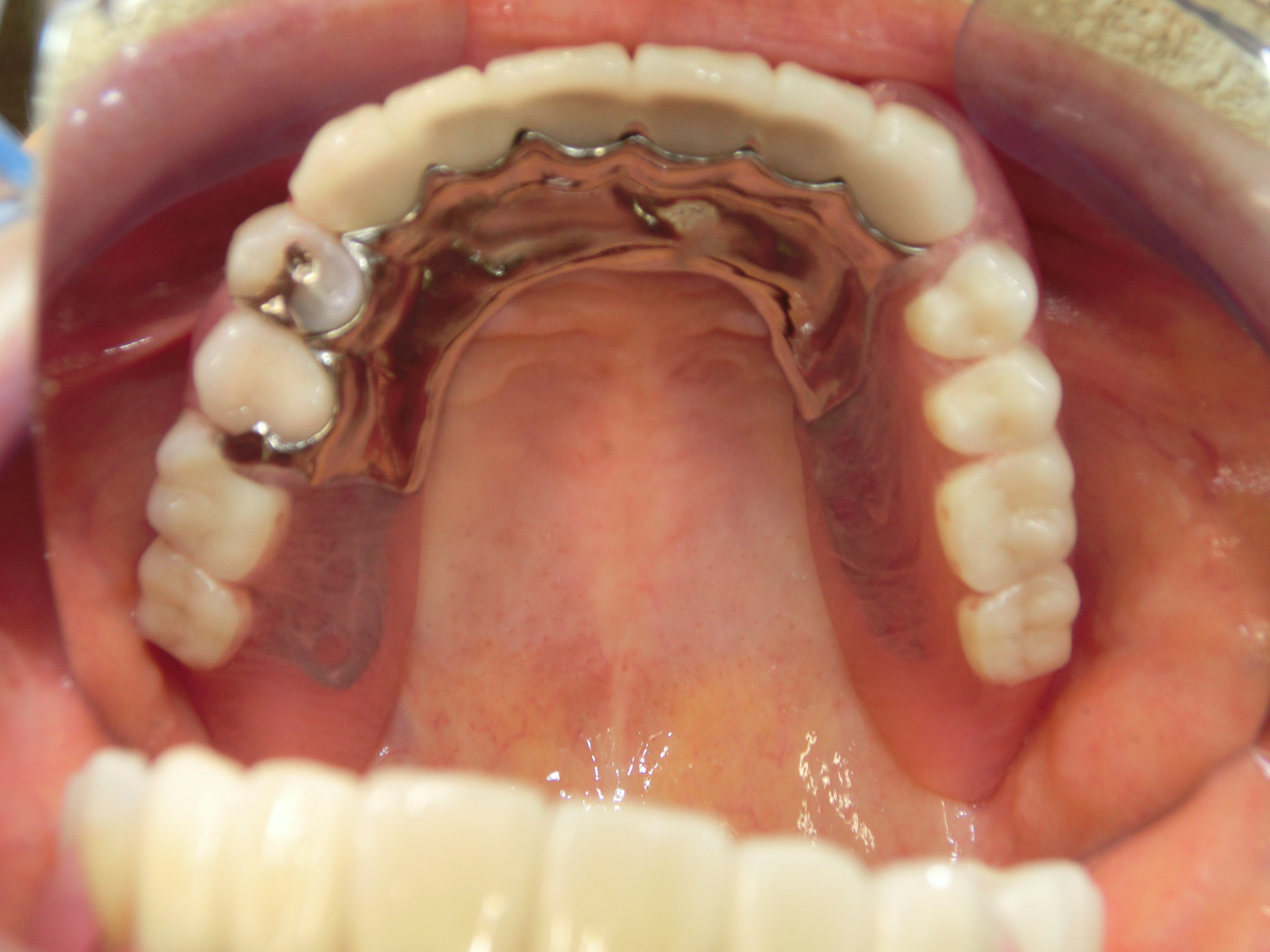 清藤歯科医院-入れ歯・義歯-コンビネーション義歯